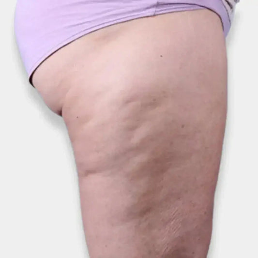 Cómo Combatir Eficazmente la Celulitis y Lograr una Piel Más Lisa y Firme